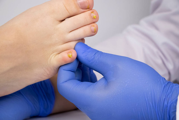 Dermatolog bada paznokieć u stóp dotkniętych grzybem. Leczenie grzybicy i pomoc dla pacjentów z chorobami grzybiczymi. - Zdjęcie, obraz