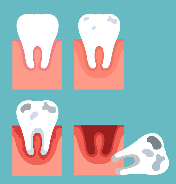 Diş çürüğünün aşamaları - Vektör, Görsel