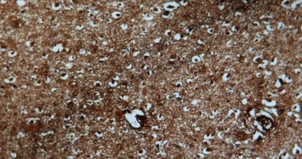 Hirngewebe eines Alzheimer-Patienten unter dem Mikroskop vergrößert - Filmmaterial, Video