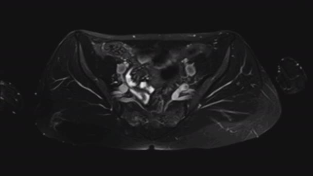 RM degli organi pelvici femminili, cavità addominale, tratto gastrointestinale e vescica - Filmati, video