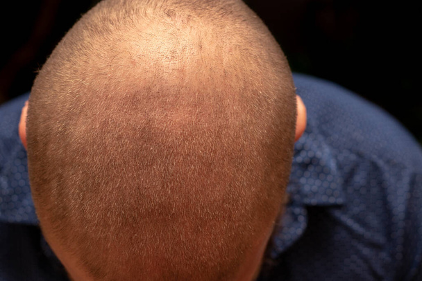 Blick von oben auf die Glatze eines Mannes, zurückgenommener Haaransatz. Vereinzelt auf schwarzem Hintergrund - Foto, Bild