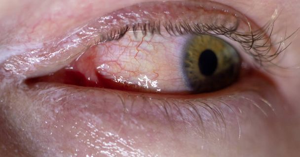 Infección ocular inflamada. Ojo rojo ensangrentado primer plano macro resultado de alergias y cansancio. Piel roja acuosa alrededor con crema curativa aplicada - Foto, Imagen
