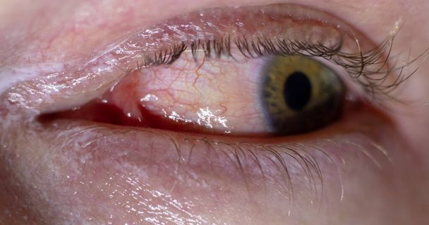 Inflamated eye infection. Red bloody eye closeup macro result of allergies and tiredness. Watery red skin around with healing creme applied - Photo, Image