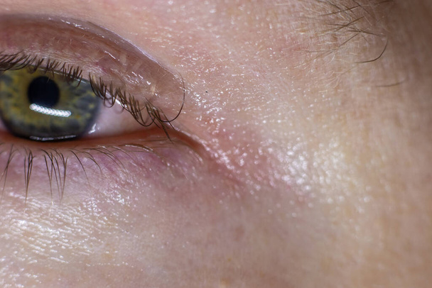 Puhallettu silmätulehdus. Punainen verinen silmänympärysmitta makrotulos allergioista ja väsymyksestä. Vesi punainen iho ympärillä parantavaa creme sovellettu - Valokuva, kuva