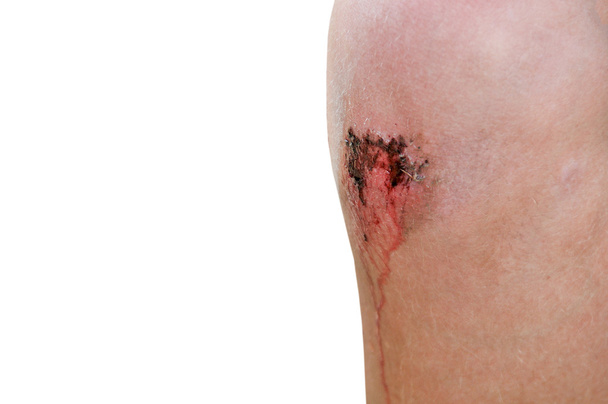 lehce odřené koleno - Fotografie, Obrázek