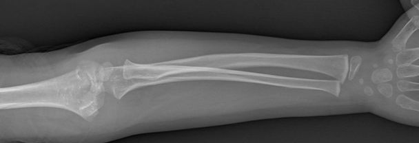 Radiografia del braccio rotto
 - Foto, immagini