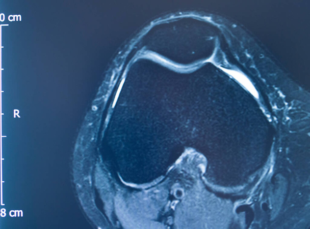 Polviurheiluvamma MRI luokka 2 kyynel magneettikuvaus ortopedinen traumatologinen skannaus. - Valokuva, kuva