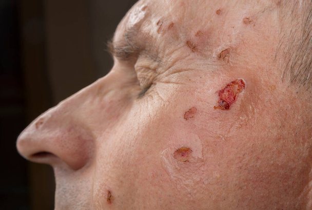 Wunde vom Laser im Gesicht vom Hautarzt - Foto, Bild