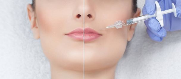 Косметолог делает инъекции ботулинового токсина в губы пациента. Фото крупным планом до и после процедуры - Фото, изображение