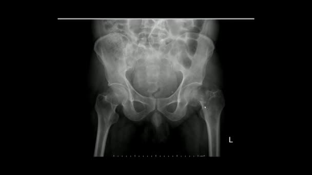 左大腿骨首骨折を示す骨盤のX線(X線骨盤)放射線検査 - 映像、動画
