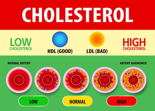 Холестерин в артерії, ризик для здоров'я, векторний дизайн
 - Вектор, зображення