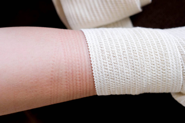 A pattern on the skin from a medical bandage. Removed the elastic bandage. - Photo, Image