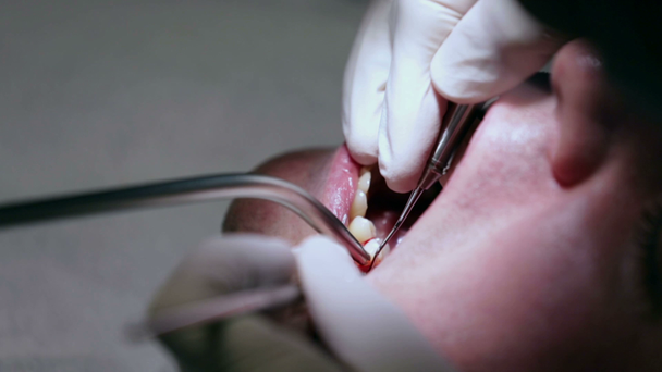 Οδοντίατρος χρησιμοποιώντας τα εργαλεία του σε καλύτερη κατάσταση δόντια πελάτες - Πλάνα, βίντεο