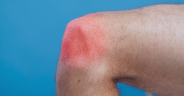 Боль в коленях, вблизи мужской ноги с пульсирующей красной зоной - Кадры, видео