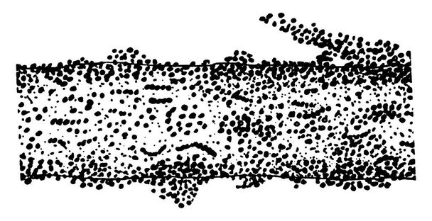 Un capello del cuoio capelluto infestato da uno stampo che produce tigna. Ringworm può verificarsi ovunque sul corpo, ma è forse più comunemente sul cuoio capelluto e del viso, disegno a linee vintage o incisione illustrazione. - Vettoriali, immagini