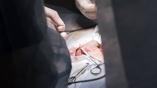 Nahaufnahme eines chirurgischen Prozesses in einem sterilen Raum. Handeln. Ärzte mit Schutzhandschuhen, die Operation mit Operationswerkzeugen durchführen und das Leben eines Patienten retten, Medizinkonzept. - Foto, Bild