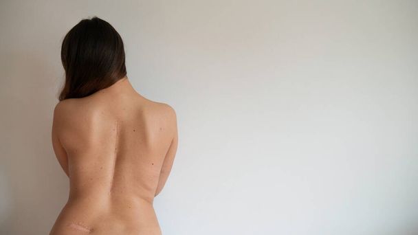 Обнаженная задница белой женщины со шрамами от операции на позвоночнике. Копирование текста. - Фото, изображение