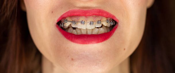 brasket system in smiling mouth, macro photo teeth, close-up lips, macro shot, dentist. Red lips - Foto, imagen