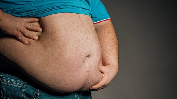 Nadváha lidského těla s rukama dotýkajícími se břicha. Koncept obezity. - Fotografie, Obrázek