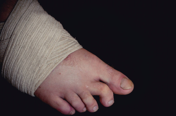 Крупный план мужской ноги с наложением временной повязки при переломе и натяжении связок. Правая нога белого человека со сломанным пальцем ноги. Первая помощь при переломах и растяжениях. - Фото, изображение