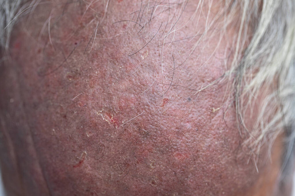 A physical of Atopic dermatitis (AD), also known as atopic eczema, is a type of inflammation of the skin (dermatitis). - Photo, Image