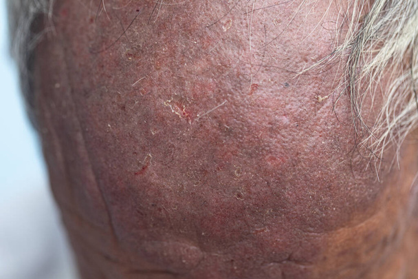 Een fysieke van Atopic dermatitis (AD), ook bekend als atopisch eczeem, is een type ontsteking van de huid (dermatitis)). - Foto, afbeelding
