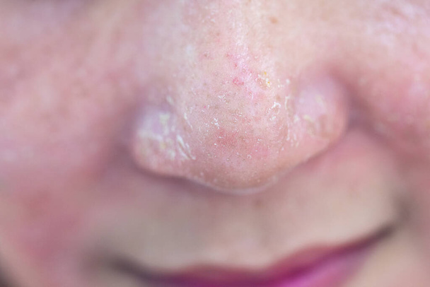 Backgrounds των βλαβών του δέρματος που προκαλείται από ακμή στο πρόσωπο στην κλινική. - Φωτογραφία, εικόνα