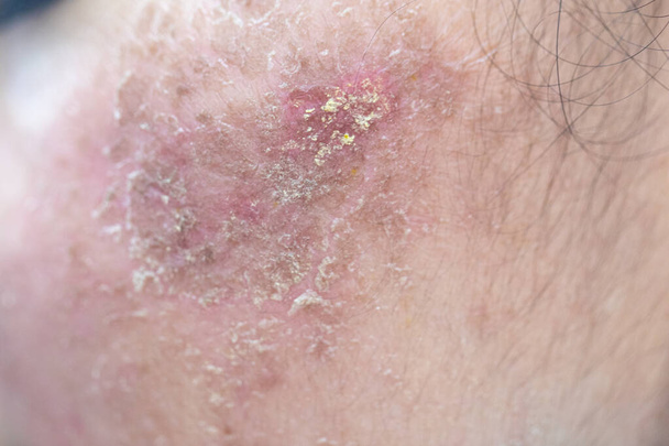Antecedentes de lesões na pele causadas pela acne no rosto na clínica. - Foto, Imagem