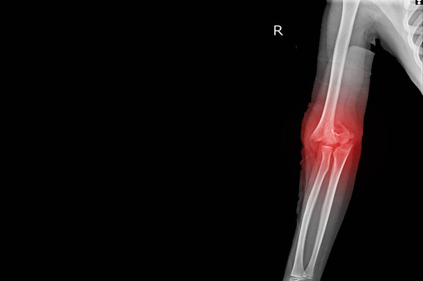 X-ray Articulation du coude Recherche Fracture supracondylaire humérus distal avec épanchement articulaire.. - Photo, image