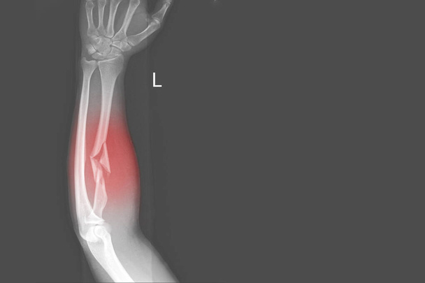 Рентгеновский обзор предплечья AP показывает перелом или сломанный проксимальный отёк левой и мягких тканей на красной точке с коповым пространством, концепция медицинского изображения. - Фото, изображение