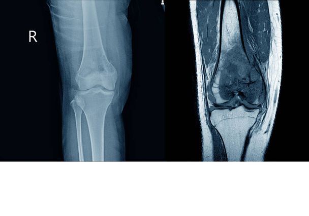 Röntgen- und MRT-Knieoperation mit großem osteolytischen Läsuion des medialen Aspekts des rechten distalen Femur.mit weicher Titanmasse und bösartigem Knochentumor, Verdacht auf Osteosarkom. - Foto, Bild