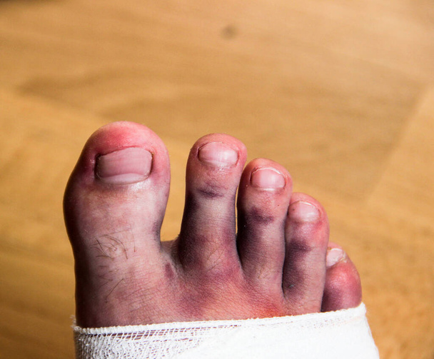 Una pierna de hombre después de una lesión con moretones y una venda. Hombre herido pierna con moretones rebobinado con yeso fundido. - Foto, Imagen