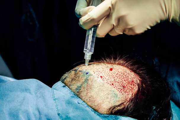 Zbliżenie ręki chirurga zastrzyk znieczulający w głowę Dokonywanie operacji przeszczep włosów na głowie na sali operacyjnej, leczenie łysienia - Zdjęcie, obraz