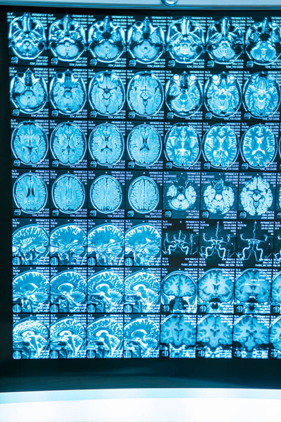 X-ray image of the brain computed tomography. Neurosurgery concept. - Zdjęcie, obraz