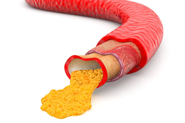 Artery blocked with cholesterol - Photo, Image