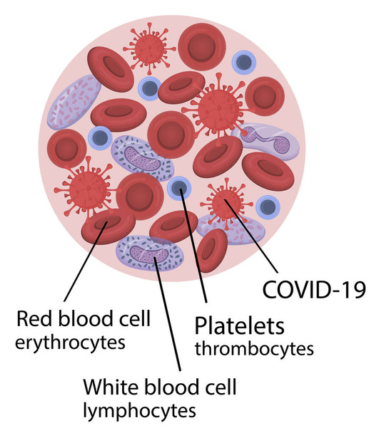 Mit Coronavirus infiziertes Blut - Vektor, Bild