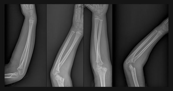 Radiografía de brazo roto
 - Foto, Imagen