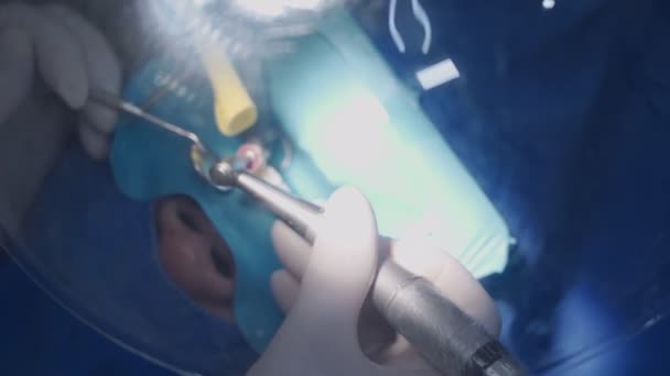 Közelkép fogorvos operáló beteg, viseljen fehér védőkesztyű berendezések eszközök fertőtlenítő, speciális fogászati fúróeszközök orvos és asszisztens, fogászati tükör, terjed vírus, fröccsenő víz   - Felvétel, videó