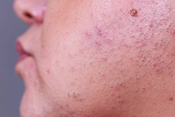 Skin after laser removing unwanted hair from face. Detail view. Epilation and cosmetology procedure. - Foto, Imagem
