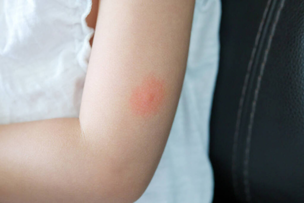 A kislánynak bőrkiütése van és allergiás a szúnyogcsípésre. - Fotó, kép