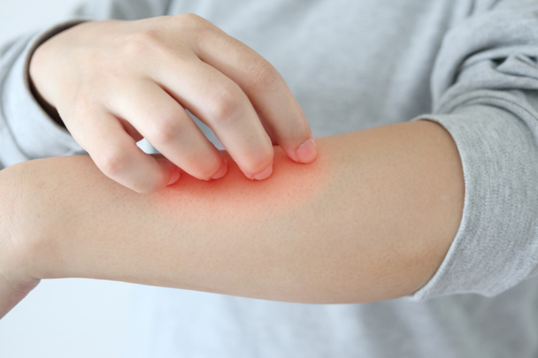 Молода азіатка свербить і подряпається на руці від сверблячки сухої шкіри екземи дерматиту
 - Фото, зображення
