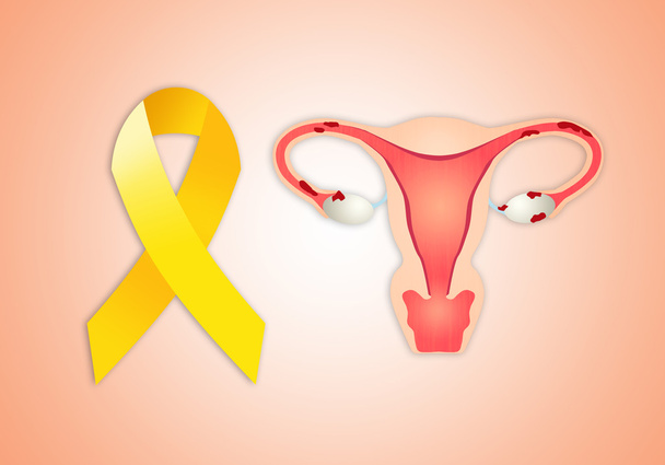 Endometriose - Foto, afbeelding