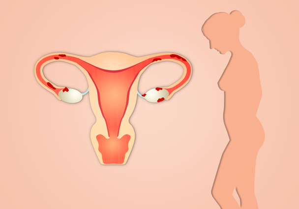Endometrioza - Zdjęcie, obraz