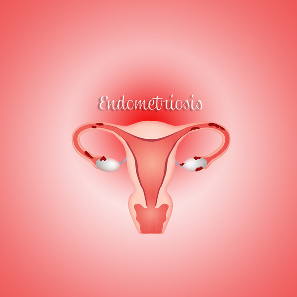 Endometrioum com endometriose
 - Foto, Imagem
