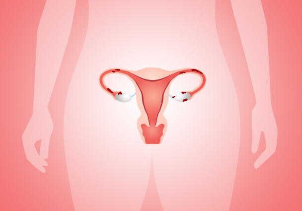 Endometriose - Foto, Imagem