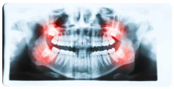 Image radiographique panoramique des dents et de la bouche avec les quatre molaires ve
 - Photo, image