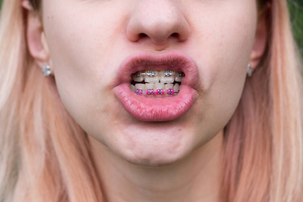 Belle jeune fille avec des appareils dentaires en métal avec des dents blanches
 - Photo, image