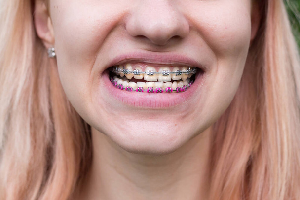Mooi jong meisje met metalen tandbeugels met witte tanden - Foto, afbeelding