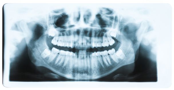 Panoramic x-ray image of teeth and mouth with all four molars ve - Photo, Image