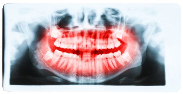 歯とすべての 4 つの臼歯 ve で口のパノラマ x 線画像 - 写真・画像